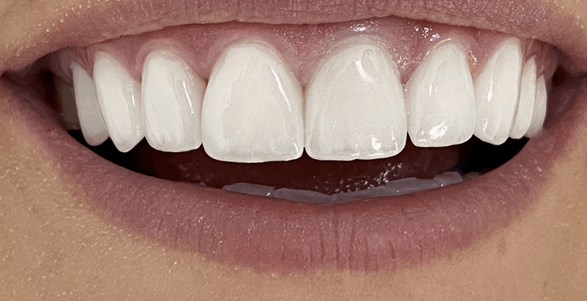 Sbiancamento dei denti