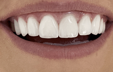 Sbiancamento dei denti