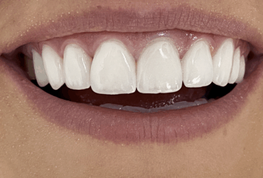 Sbiancamento dei denti